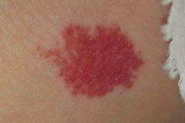 红胎记算命图解